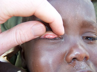 Active trachoma with follicles visble in a  Samburu child